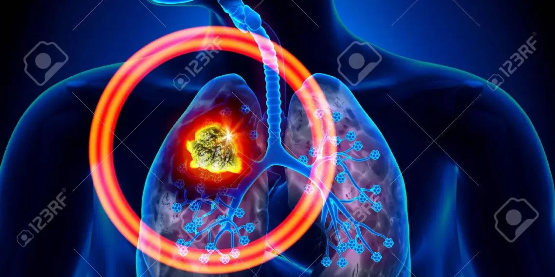 AI tool to detect lung cancer